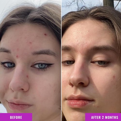 Good Molecules Niacinamide Serum Pack 2 – 30 ml Each (Total 60 ml) | 10% Niacinamide Serum to Target Blemishes, Uneven Skin Tone & Enlarged Pores