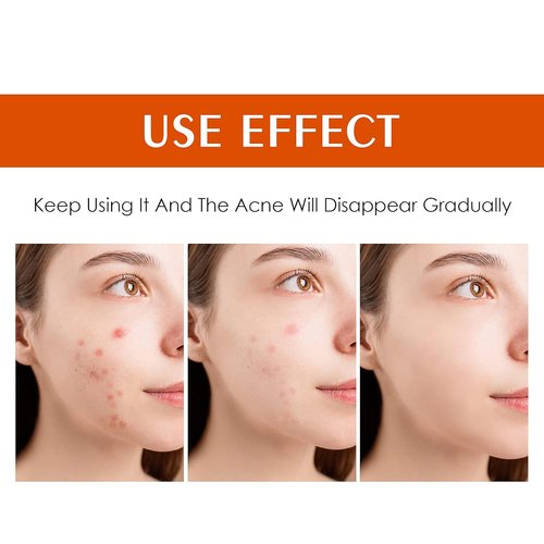 Regine Switzerland Acne Treatment Cream - Rapid Clearing for Hormonal & Cystic Acne | 30g