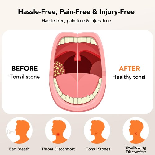 Electric Tonsil Stone Remover Vacuum – 8 Suction Levels with LED Light, Safety Pause Button & Oral Protection | High-Precision Tonsil Stone Removal Kit with 13 Attachments for Painless Cleaning