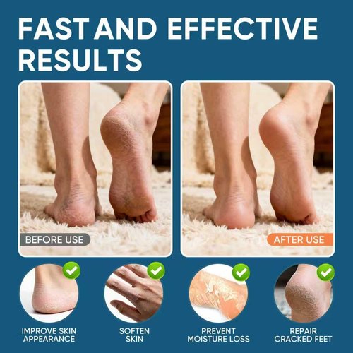 Regine Switzerland Urea Cream 60% with Salicylic Acid | Maximum Strength Foot Cream for Dry, Cracked Heels