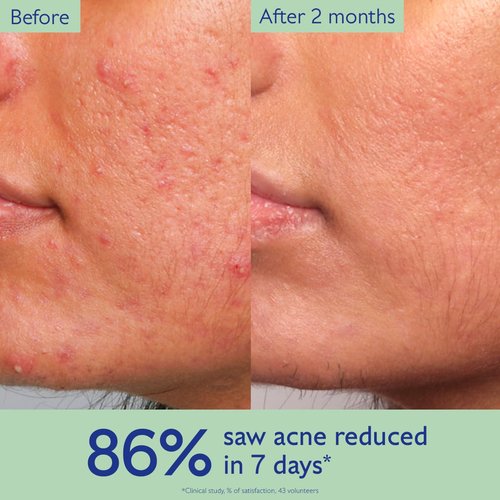 Caudalie Vinopure Acne Serum - Treat & Prevent Blemishes | Includes 2 Free Travel-Sized Products