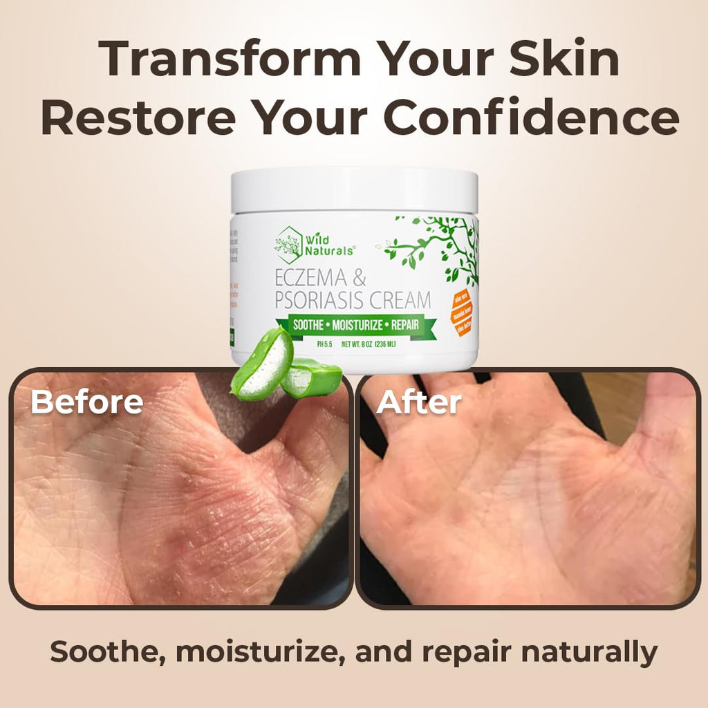 Wild Naturals Eczema & Psoriasis Cream - Soothing Relief for Dry, Itchy Skin | Moisturizing with Manuka Honey