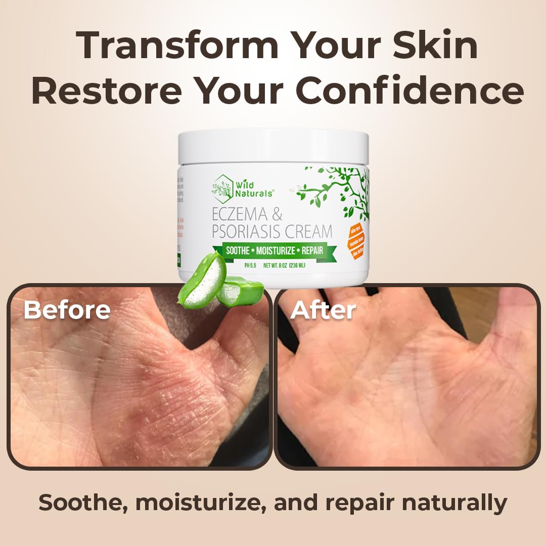 Wild Naturals Eczema & Psoriasis Cream - Soothing Relief for Dry, Itchy Skin | Moisturizing with Manuka Honey