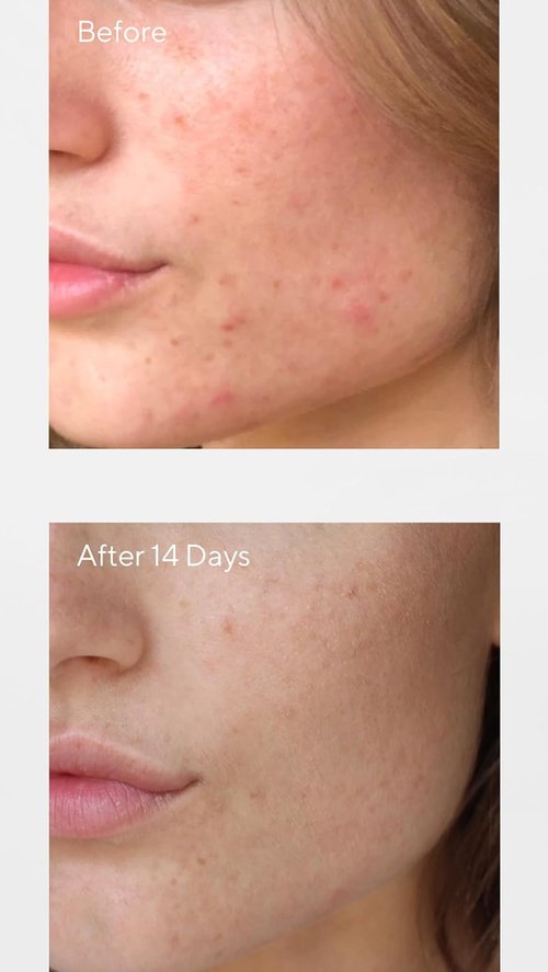 Murad Women's Invisiscar Resurfacing Treatment - Advanced Scar Repair Cream | 1.7 oz
