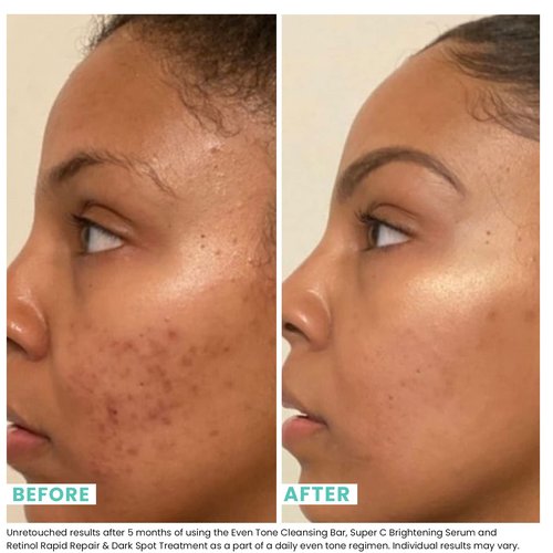 Urban Skin Rx® Even Tone Cleansing Bar | 3-in-1 Multitasking Treatment Daily Cleanser, Exfoliator, & Mask | Targets Uneven Skin & Improves the Appearance of Dark Spots | Includes Applicator | 2.0 Oz