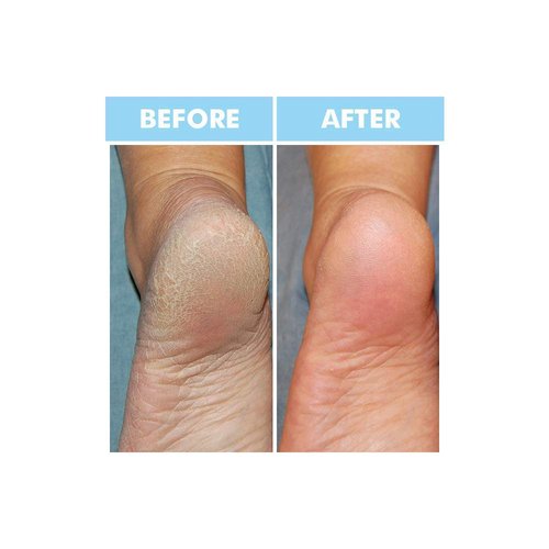 Bodipure Premium Hand and Foot Mask | Moisturizing Kertain Gloves & Socks | Hydrating Dull Dry Hands, Cracked Heels, Callus Softening & Nail Strengthening | Chemical-Free Feet Treatment | (6+6 Pack)