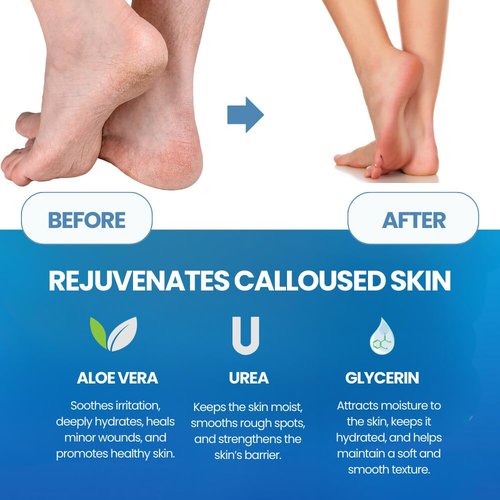Imperial Feet Callus Remover for Feet Extra Strength Set – Callus Softener Spray + Stainless Steel Foot File, Hard Skin Remover for Dry Cracked Heels, Foot Dead Skin Remover for Pedicure