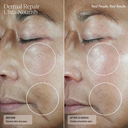 Senté Dermal Repair Ultra-Nourish - Rosacea Treatment for Dry, Sensitive Skin | Repairs & Reduces Redness | 1.7 Fl Oz