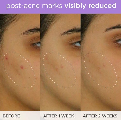 Brightening Serum - Vitamin C Treatment for Brighter, Firmer Skin | Targets Hyperpigmentation & Fades Post-Acne Marks, 30 ml