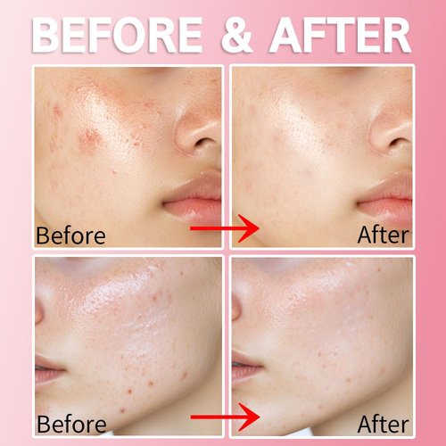 Purederm Blemish Spot Treatment Gel - Soothing Acne Care with 2% Salicylic Acid | 20ml