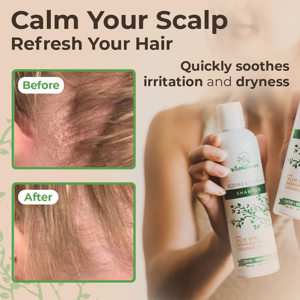 Wild Naturals Eczema & Psoriasis Shampoo - Anti-Dandruff Relief for Itchy Scalp | Hypoallergenic & Fragrance-Free