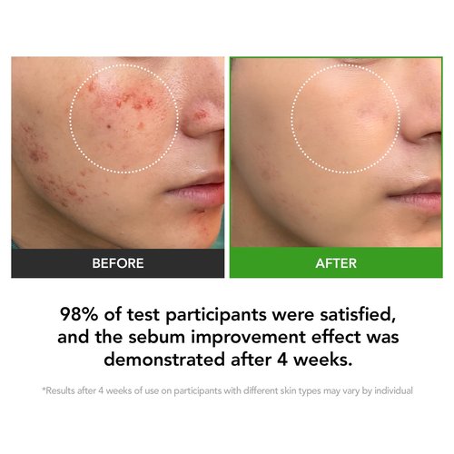 KIOSKIN 31% Reduction in Sebum & 15.5% High-Dose D-Panthenol | Calms Redness, Repairs Skin Barrier & Locks in Hydration | With Heartleaf Extract | Korean Skincare Daily Moisturizer (35 ml/1.18 fl.oz.)