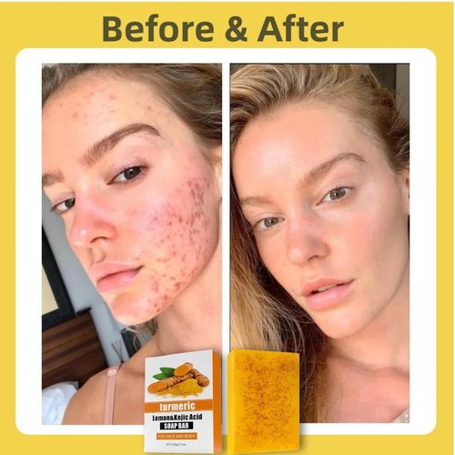 Uselective 3 Pack Lemon & Turmeric Soap Bar for Dark Spots, Powered by Kojic Acid, Vitamin C - Deeply Moisturizing with Amino Acids & Shea Butter - SLS Free for Face/Body