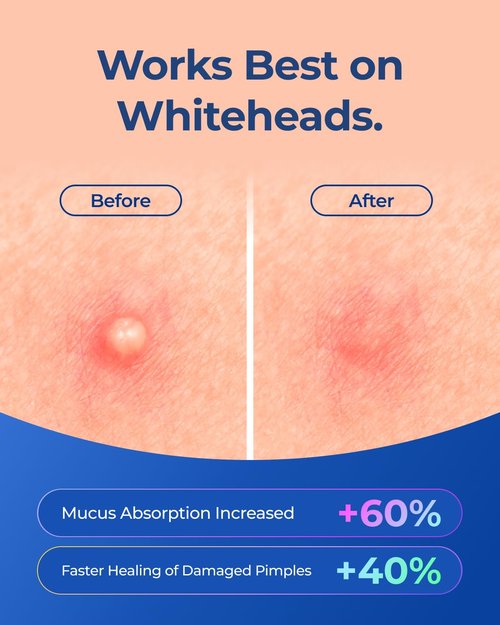 POINTMASS Star Pimple Patches for Face: Cute Acne Dots Hydrocolloid Stickers, Strong Absorption, 6 Colors, 312 Patches, Overnight Care