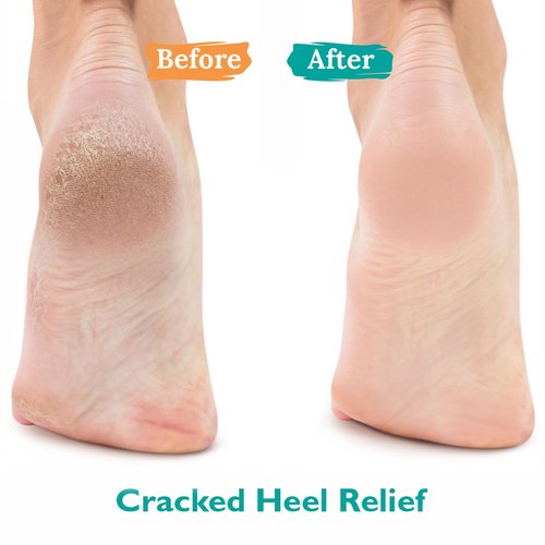 Gilden Tree Urea Gel 42% - Maximum Strength Formula for Softening Cracked Heels & Thick Toenails