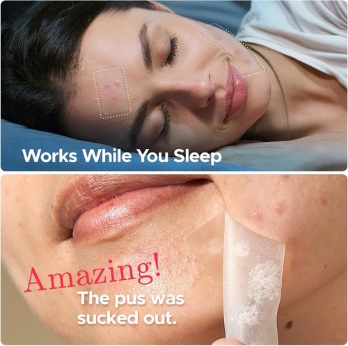 LitBear Large Pimple Patches, 5 Sizes 324 Patches Big Acne Patches, XL Hydrocolloid Bandages for Full Face, Forehead, Chin, Nose, Body, Back, Neck & Chest, Stirp, Square Large hydrocolloid Patch
