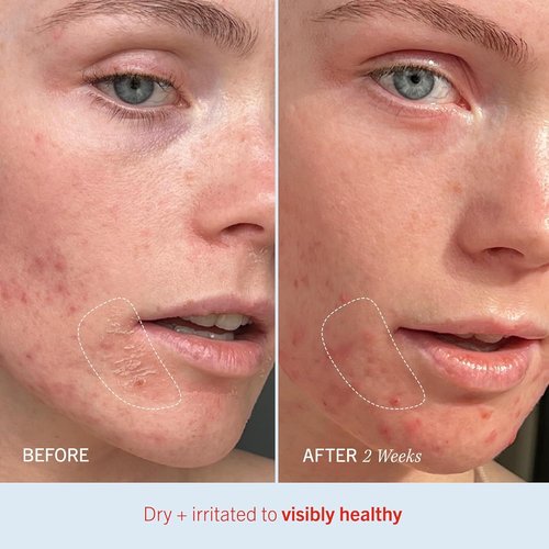 First Aid Beauty - Ultra Repair Cream | Intense Hydration with Whipped Oatmeal, 14oz Fresh Strawberry