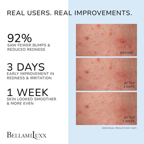 BellamiLuxx Folliculitis Acne Lotion - Soothes Itch & Redness, Reduces Body Acne & Bumps | Salicylic & Glycolic Acid + Botanicals