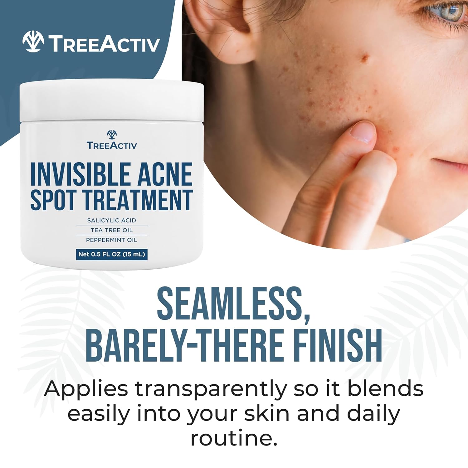 TreeActiv Acne Spot Cream - Clear-Drying Formula with Salicylic Acid & Tea Tree Oil | 150+ Uses for Acne-Prone Skin