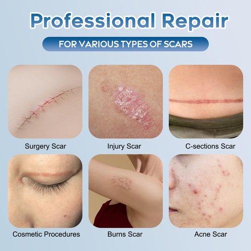 Advanced Silicone Scar Gel for Face & Body – Silicone Scar Cream for Old & New Scars, Reduces Appearance of Scars from Acne, Surgery, Burns, Injuries, C-Sections & More (1.76 Ounce)
