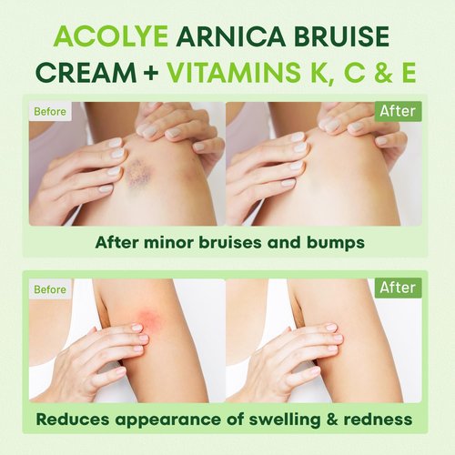 Acolye Arnica Cream for Bruising and Swelling: Extra Strength Arnica Bruise Cream with Vitamins K C E for Seniors Aged 55 and Above - Fast Healing Formula Ideal for Thin Skin 3.5 oz