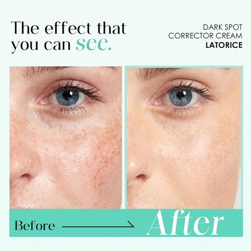 Dark Spot Remover for Face and Body: Tranexamic Acid Serum for Women and Men - Reduce Sun Spot Melasma Freckles - Natural Ingredient Enriching Skin Care (1.7 Fl Oz)