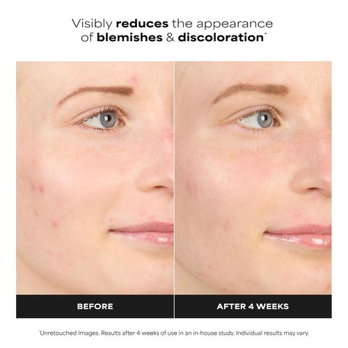 Paula's Choice BOOST 10% Azelaic Acid Serum - Oil-Free Skin Brightening Gel for Face, Fragrance-Free