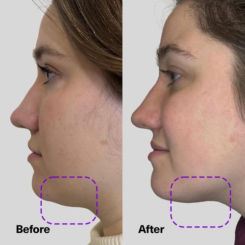 SickScience ShapeShift Advanced Jaw & Neck Firming Serum | Double Chin Reducer & Face Tightening Treatment, 1.7oz