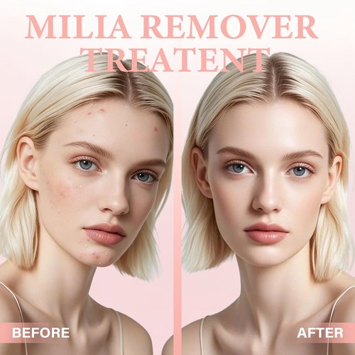 Milia Remover Serum, Improve Skin Radiance Lightweight, Oil-Free Formula for Eyes & Face