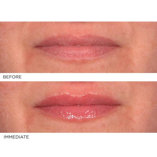 NassifMD Hydro-Screen Lip Plumping Oil - Hydrating Hyaluronic Acid Serum for Soft, Smooth Lips