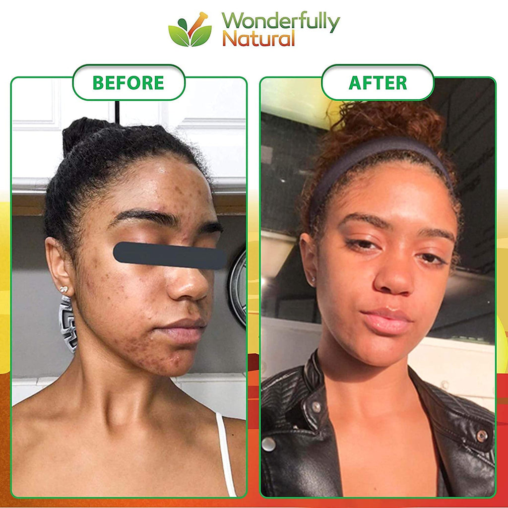 Wonderfully Natural #1 African Black Soap for Acne & Dark Spots | Organic Vegan Satisfaction Guarantee | 1lb bar 90 day Supply