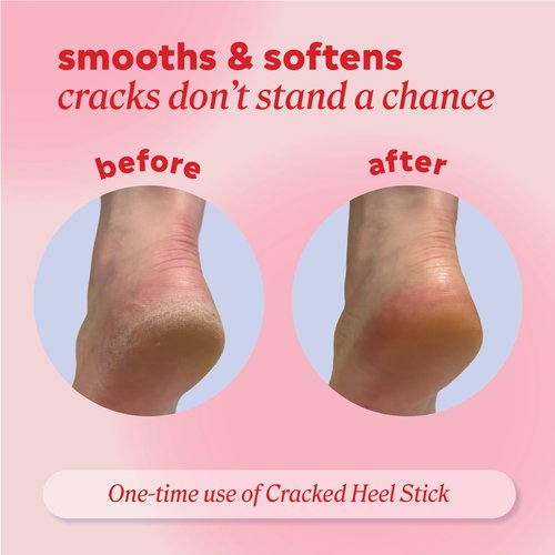 Onyx Professional Cracked Heel Repair Balm Stick for Dry Cracked Feet Treatment, Coconut Scent, 2 pack - Moisturizing Foot Balm, Rolls On, Cracked Heel Treatment
