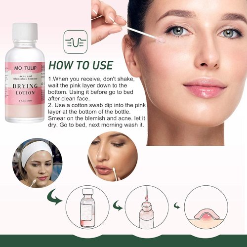 MO TULIP Acne Drying Lotion - Overnight Spot Treatment for Face & Body, 1oz Pimple & Blemish Solution