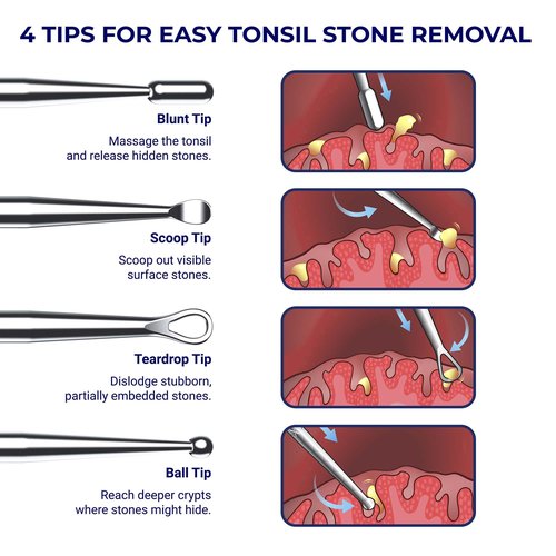 Oravix Tonsil Stone Remover Tool Pack of 2, Metal Tonsil Stone Removal Tool, 7’’ Surgical-Grade Stainless Steel Metal Pick with 10 Soft Silicone Tips, Fight Bad Breath, Safe & Easy