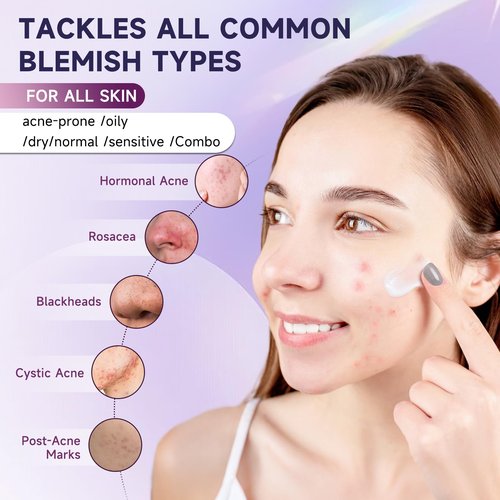 Cystic Acne Treatment for Face – Hormonal Acne Spot Treatment Pimple Cream with Azelaic Acid | Redness Reducing Acne Moisturizer for Rosacea & Sensitive, Acne-Prone Skin | Teens & Adults, 1.7 oz