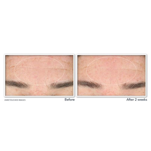 RoC Retinol Correxion Deep Wrinkle Serum - Anti-Aging Facial Cleanser with Niacinamide, 6 oz