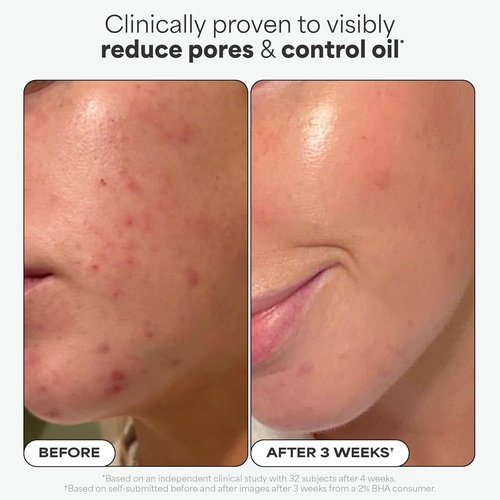 Paula's Choice SKIN PERFECTING 2% BHA Exfoliating Pads - Clear Blackheads & Minimize Pores