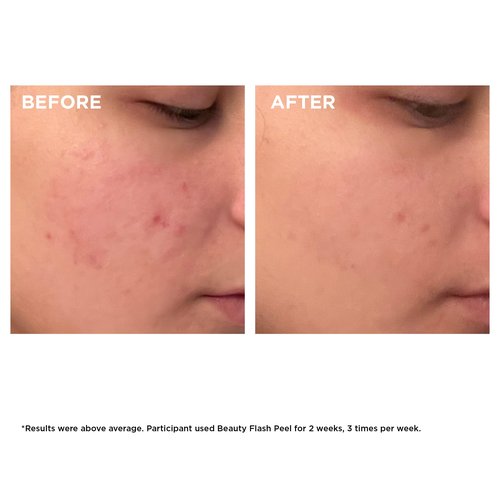 Clarins Beauty Flash Peel | 10-Minute At-Home Facial | Visibly Tightens Pores | Gently Eliminates Dead Skin Cells | Refines Skin Texture | Renews Radiance | Contains AHAs and BHAs | All Skin Types