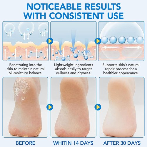 Skiennix Urea Foot Cream Stick - 60% Urea & 2% Salicylic Acid for Dry Cracked Skin | 1.41 oz