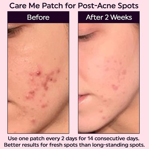Care Me Microdart Dark Spot Patch - 127 Micropoints for Fading Acne Marks & Dark Spots | 9 Patches