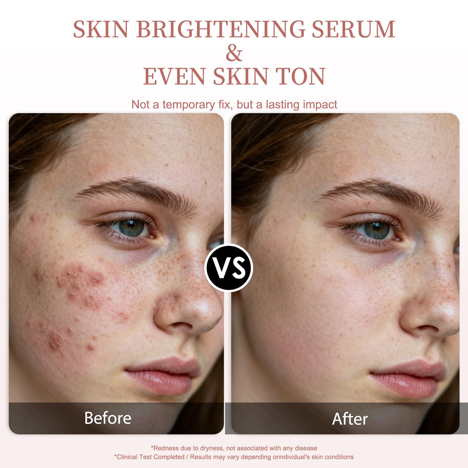 Vitamin C Serum for Face – Brightening & Anti-Aging & Wrinkle Facial Serum With Vitamin C, Sodium Hyaluronate, Vitamin E And More. Hydrating Dark Spot Corrector to Even Skin Tone & Glow, 1 fl oz