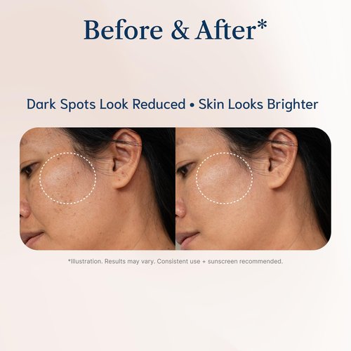 Tranexamic Acid Serum for Face – Dark Spot Remover with Niacinamide & Vitamin C | Melasma Treatment for Face, Hyperpigmentation Care 30ml / 1 fl oz