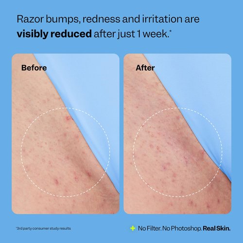 Peach Slices Ingrown Hair Treatment - Smoothing Solution with BHA, AHA, Niacinamide | 1.69 oz Vegan & Cruelty-Free