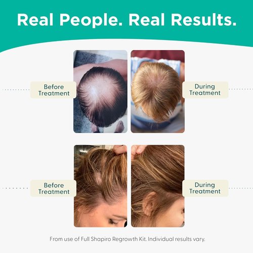 Shapiro MD Hair Growth Foam - DHT Fighting Vegan Formula for Thinning Hair | 1 Month Supply