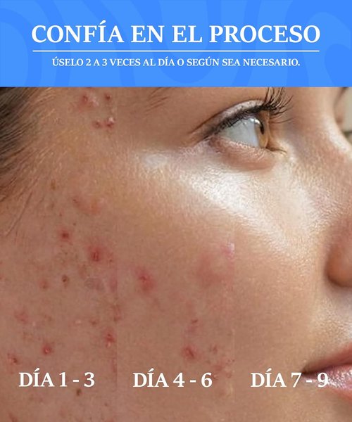 Skiennix Skin Recovery Mist - Hypochlorous Acid Face & Body Spray for Acne & Redness - 5.07 fl oz (150 ml)