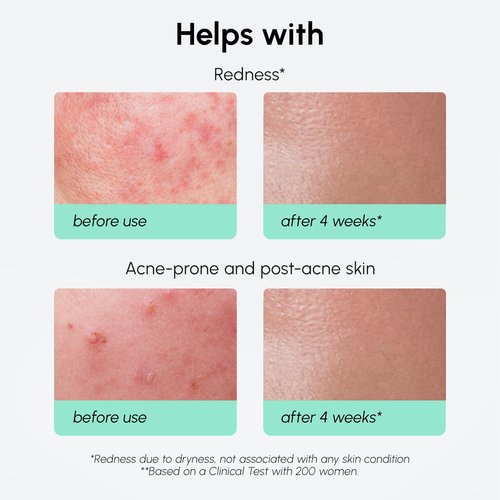 MAREE 10% Azelaic Acid Face Serum - Redness Soothing Hydrating Serum with Niacinamide, Centella Asiatica & Hyaluronic Acid - Relief Serums for Face & Body - Azalecic Acid Skin Facial - Acido Azelaico