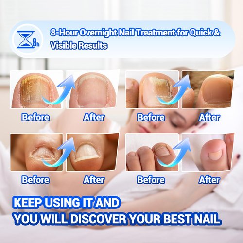 Skiennix Toenail Fungus Treatment - 50 Extra Strength Hydrogel Nail Patches for Overnight Repair