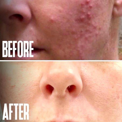 Alpha Hydroxy Acid Glycolic Acid Peel 40% - Professional Exfoliant for Acne Scars & Wrinkles