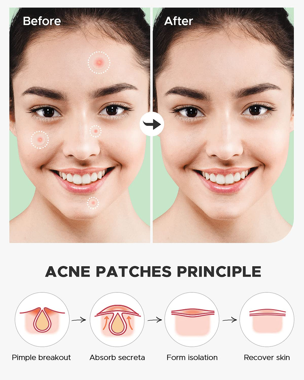 ZATKTK Pimple Patch (360 Counts 4 Sizes), Hydrocolliod Acne Patch for Face, Invisible Zit Patch with Tea Tree Oil & Calendula Oil, Blemish Patch