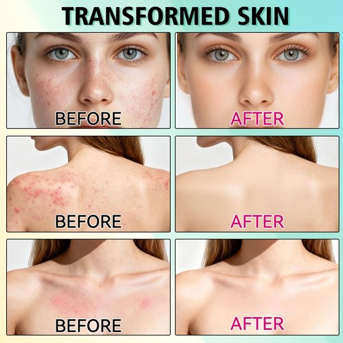 Acne Treatment for Face, Acne Cream, Pimple Cream Suitable for All Skin, Blemish Care Cream for Face and Body, Gentle Daily Skin Care for Oily & Blemish-Prone Skin, Helps Improve Skin Appearance